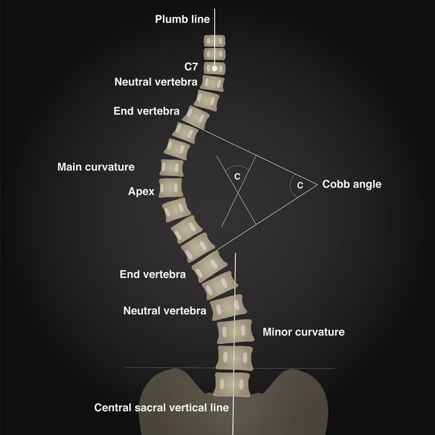 definitions-scoliosis 3D Body Scanning